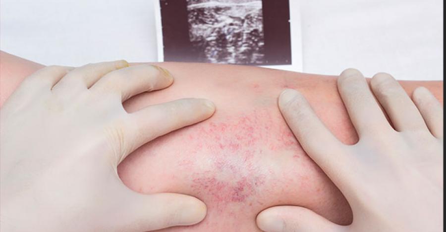 Registra México el primer caso de trombosis por la vacuna de AstraZeneca